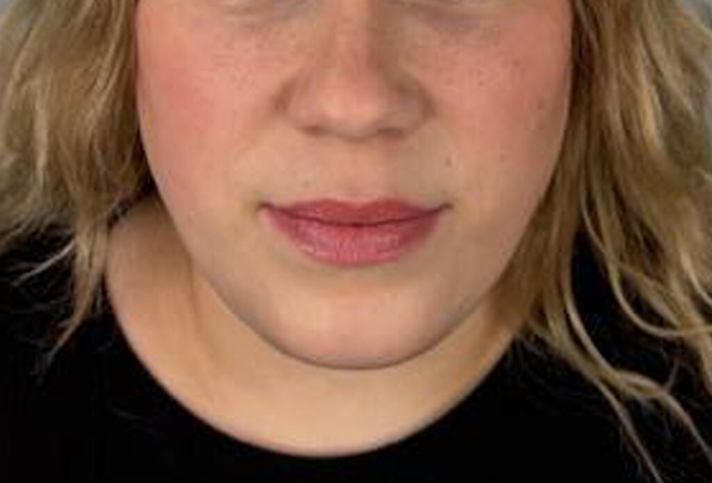 Filler Dissolving - After