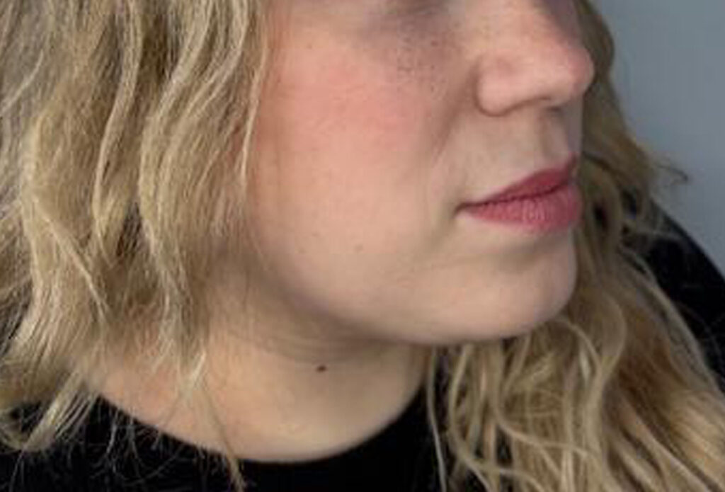 Filler Dissolving - After