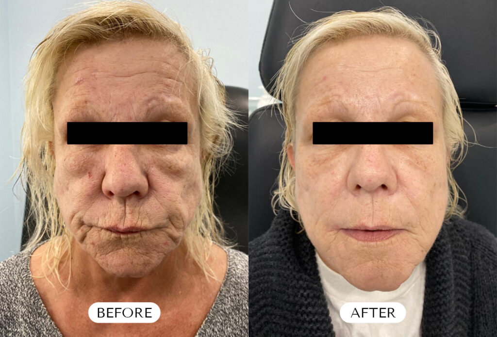 Under Eye Dissolving Filler - Before & After