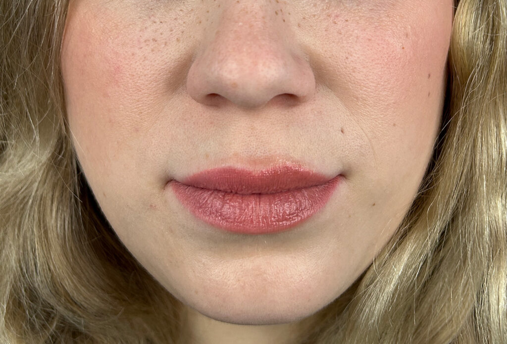 Filler Dissolving - After Refill