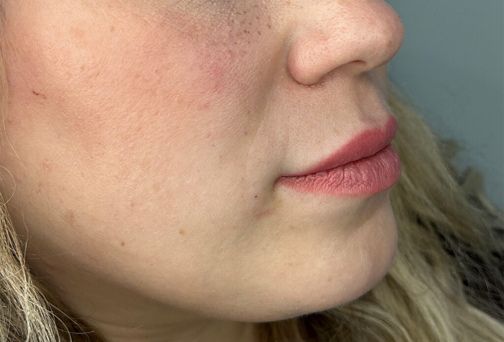 Filler Dissolving - After Refill