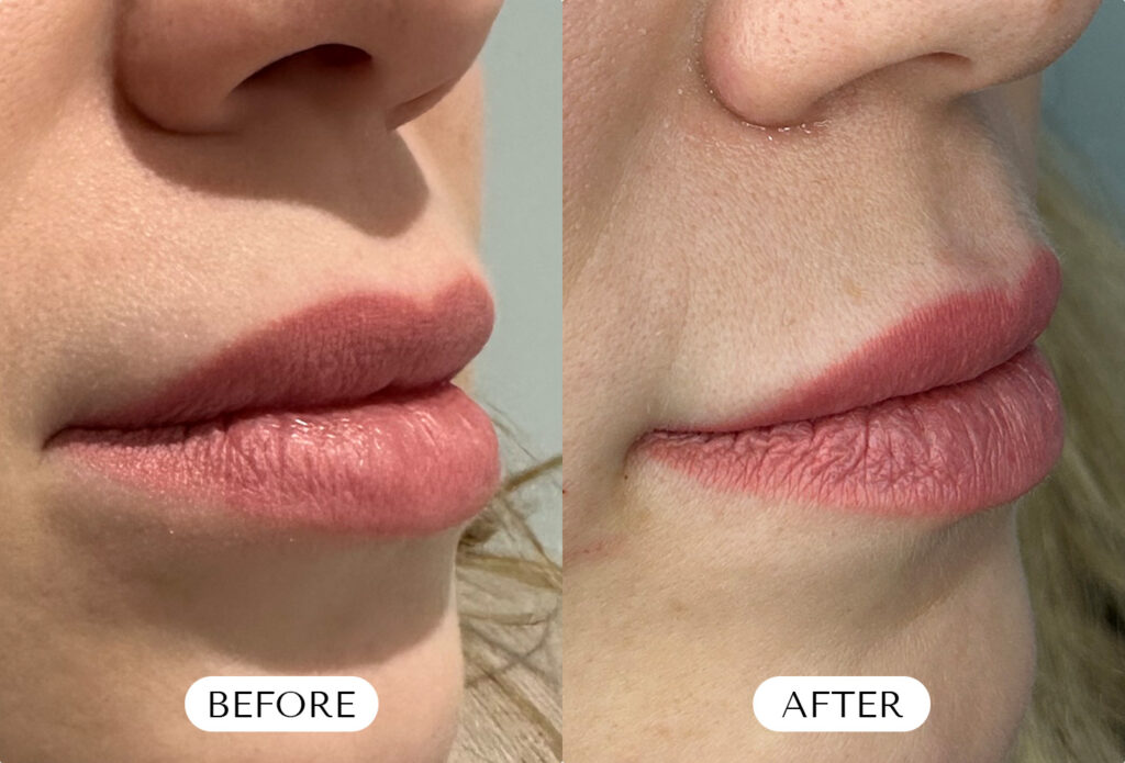 Dissolving Lip Filler - Before & After
