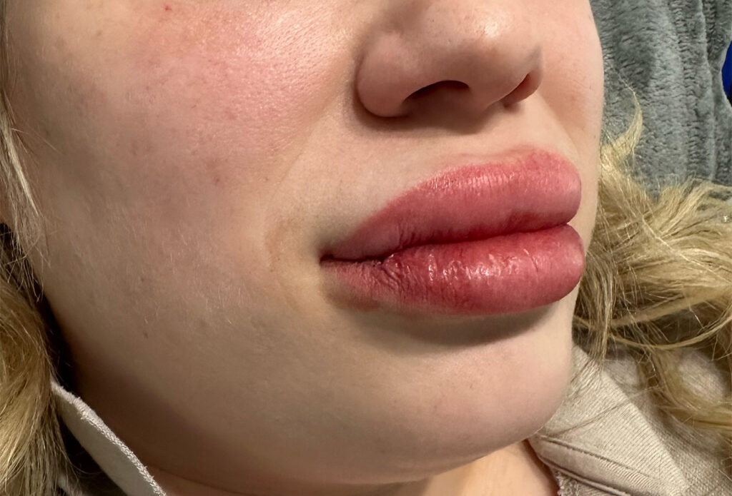 Filler Dissolving - Day of Dissolve