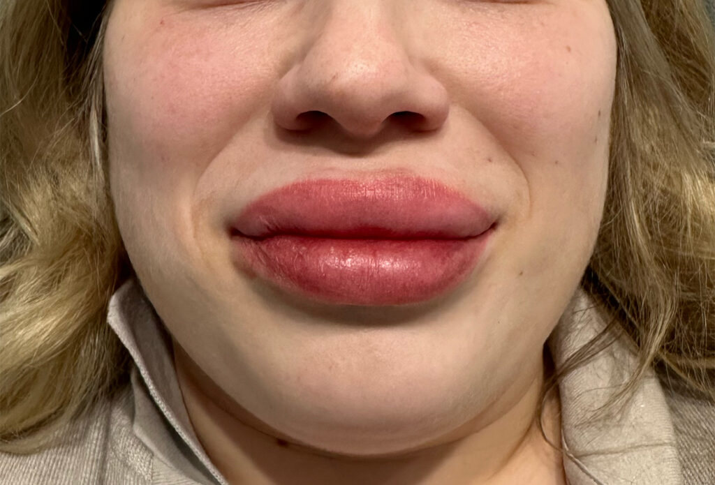 Filler Dissolving - Filler Dissolving - Day of Dissolve