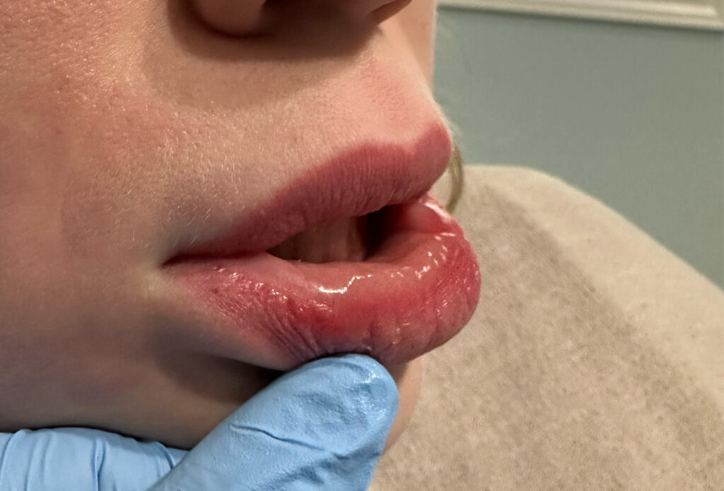 Filler Dissolving - Migrate Lower