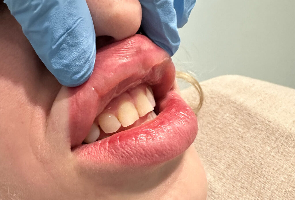 Filler Dissolving - Migrate Upper