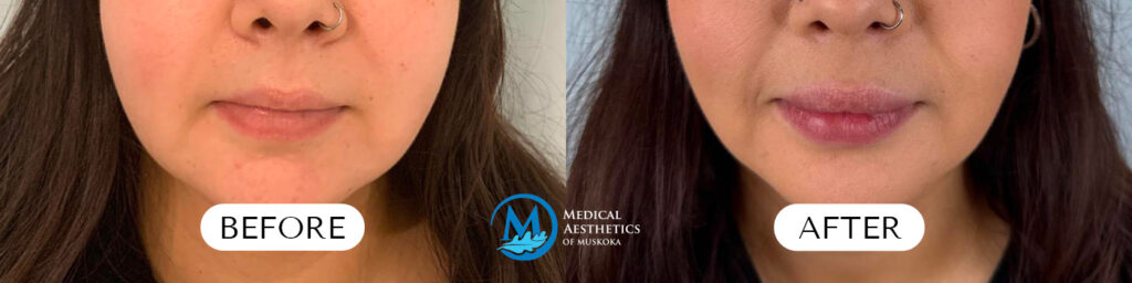 Lip Filler - Before & After