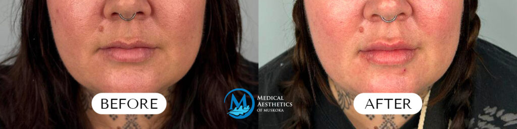 Lip Filler - Before & After