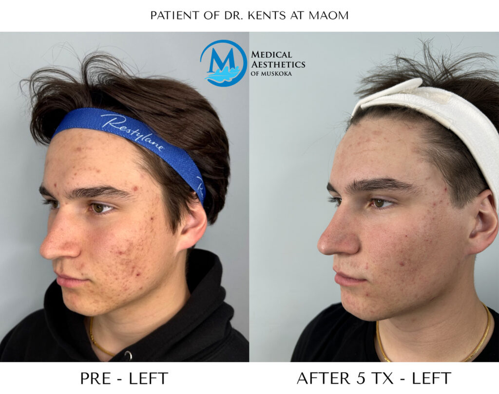 NeoGen Low Energy - Acne Progress