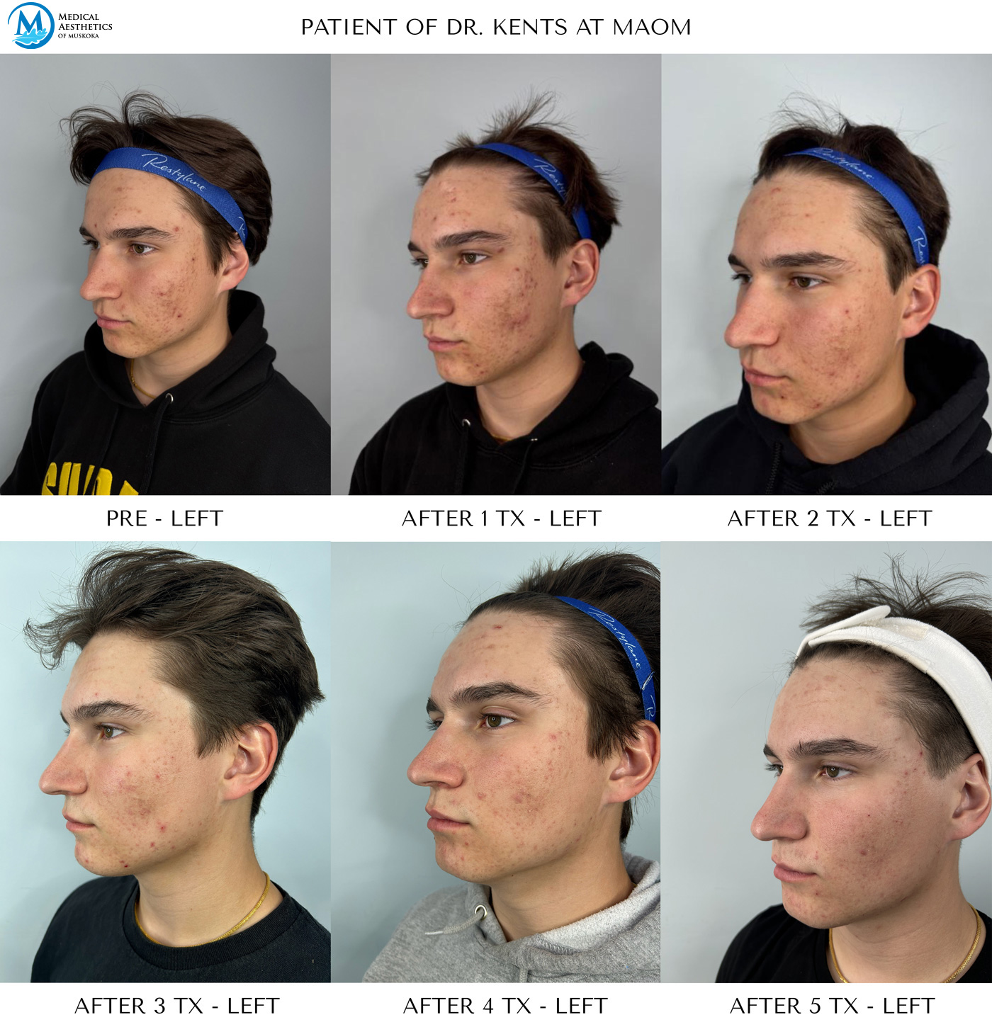 NeoGen Low Energy - Acne Progress