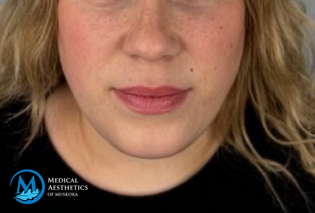 Filler Dissolving - After