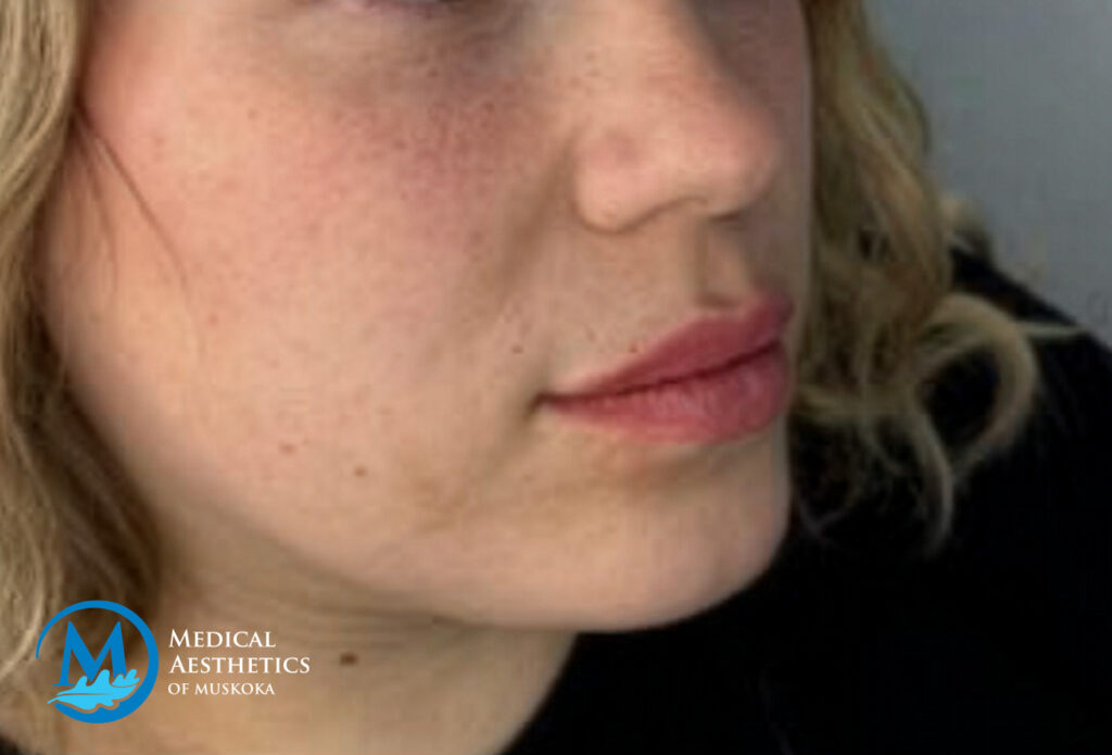 Filler Dissolving - After