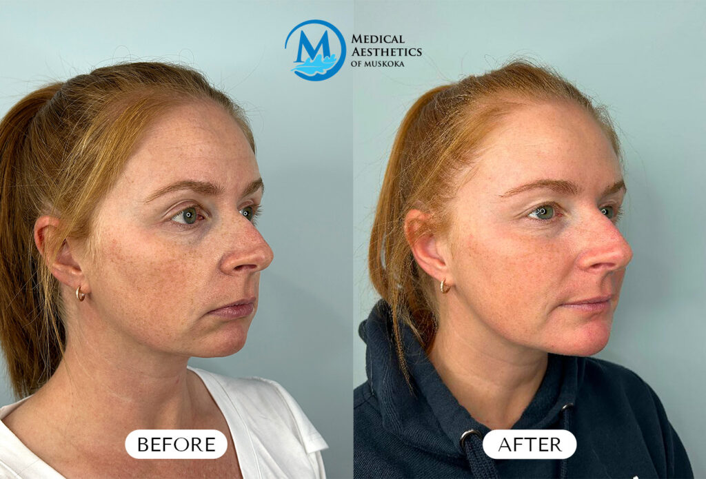 Cheek & Chin Filler - Before & After