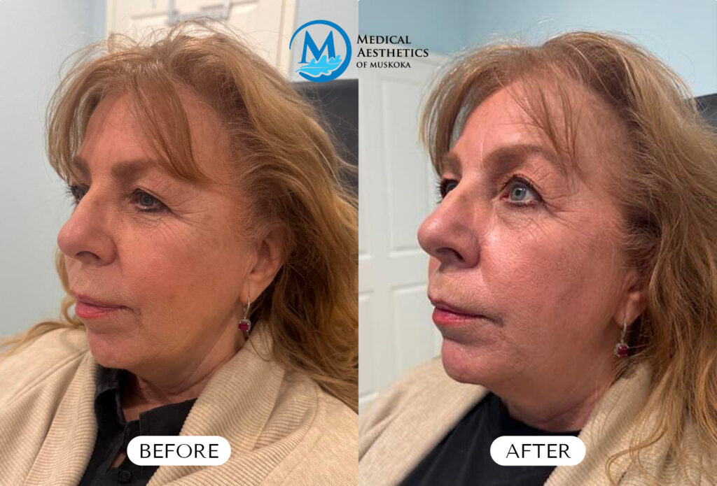 Chin Filler - Before & After
