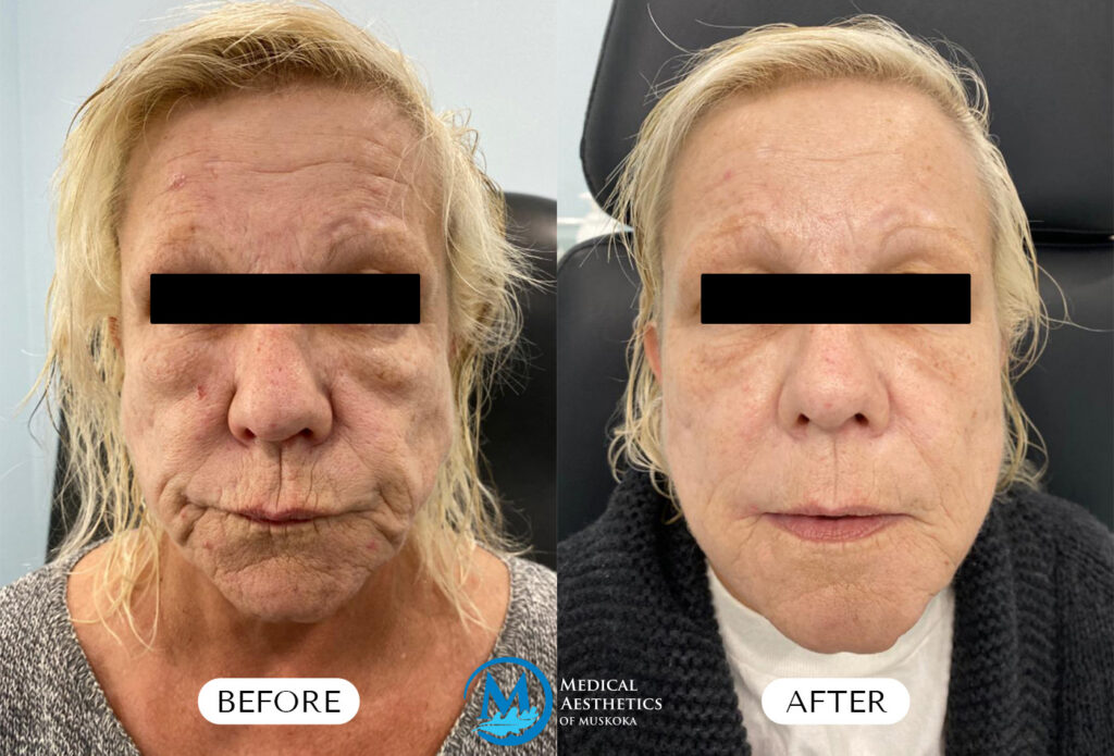Under Eye Dissolving Filler - Before & After