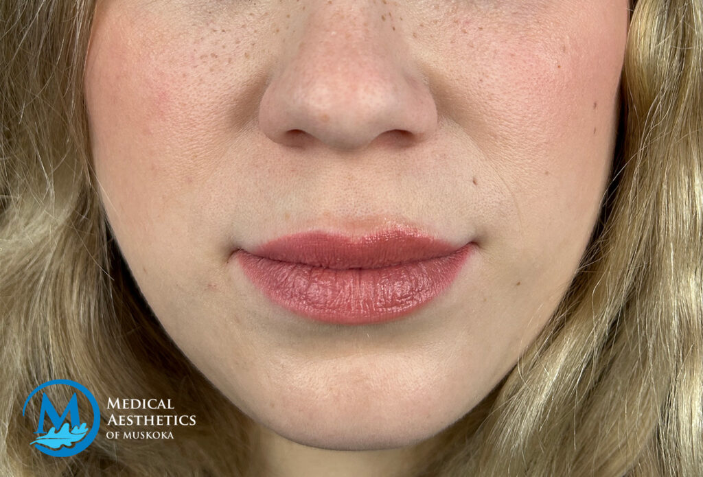 Filler Dissolving - After Refill