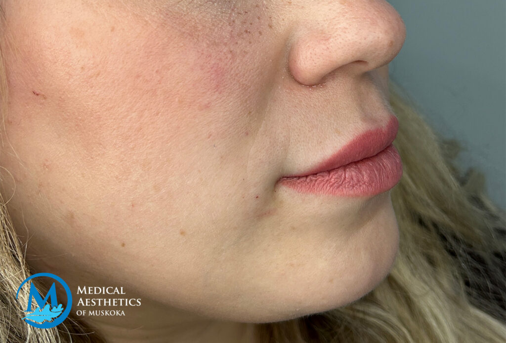 Filler Dissolving - After Refill