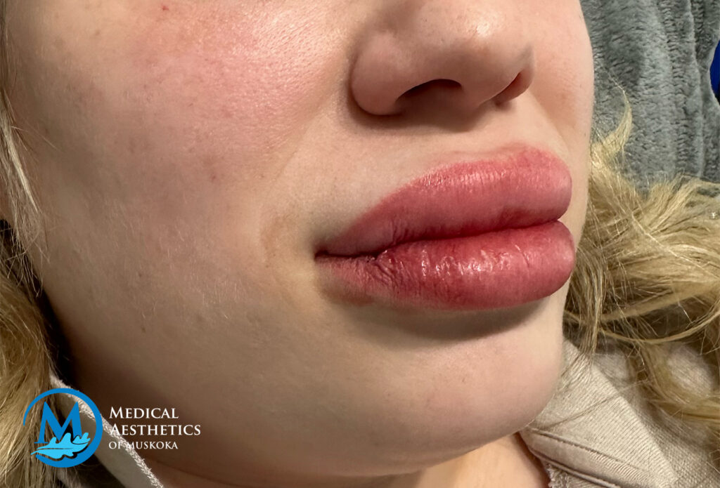 Filler Dissolving - Day of Dissolve