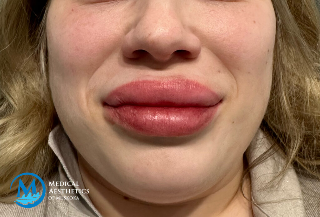 Filler Dissolving - Filler Dissolving - Day of Dissolve