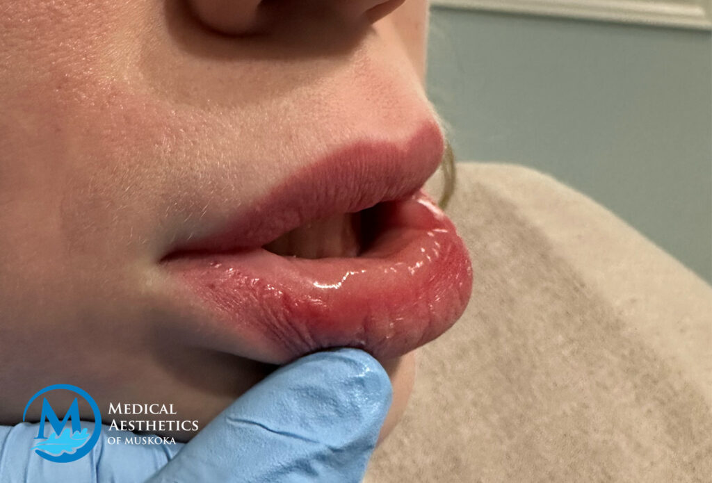 Filler Dissolving - Migrate Lower