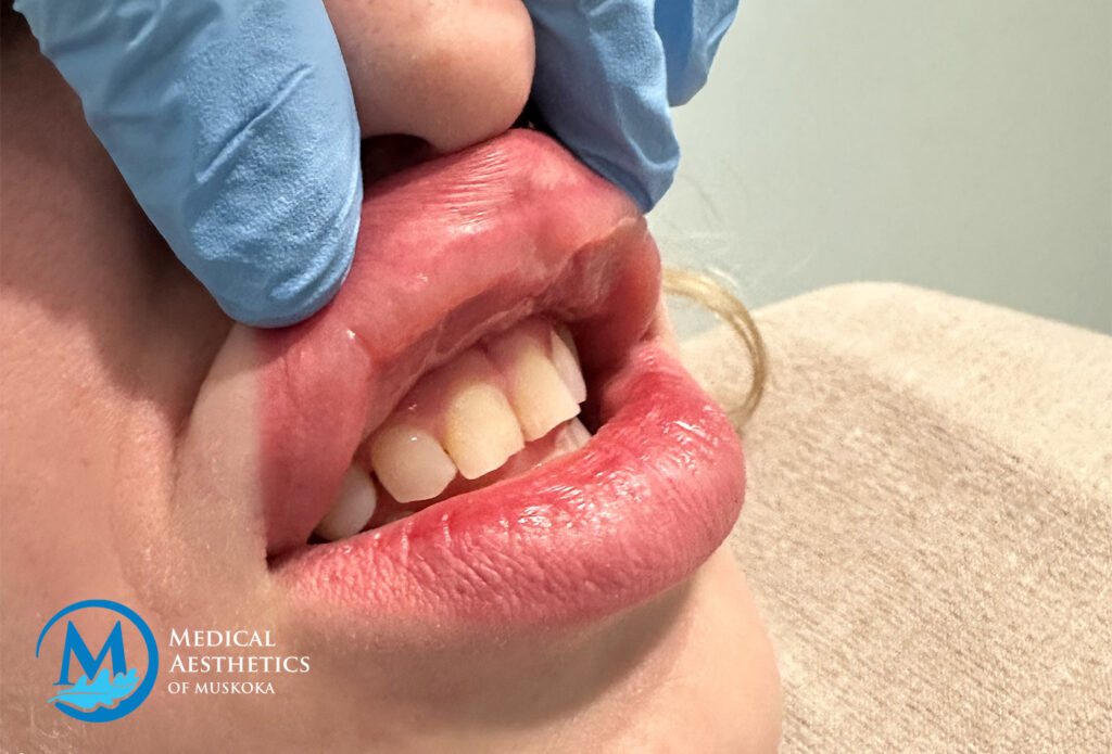 Filler Dissolving - Migrate Upper