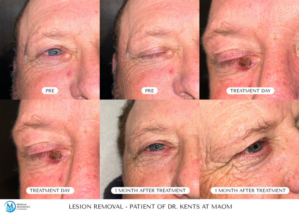 Lesion Removal Process