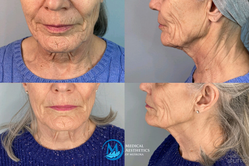 NeoGen Medium/High Energy